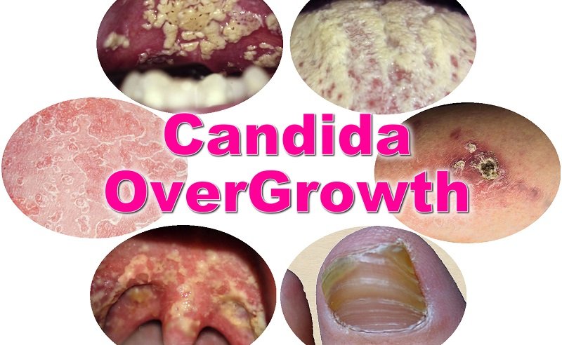 Candida Overgrowth