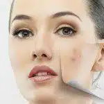 Adult Acne: Causes and Remedies by ultraceuticals.com