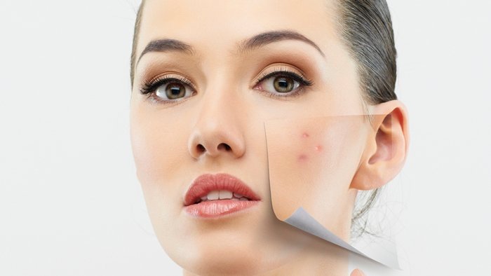 Adult Acne: Causes and Remedies by ultraceuticals.com