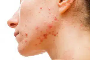 Adult Acne: Causes and Remedies by ultraceuticals.com