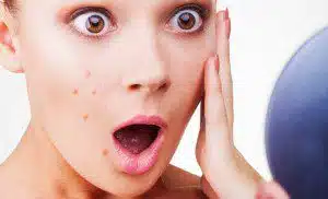 Adult Acne: Causes and Remedies by ultraceuticals.com