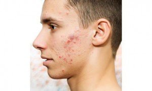 Adult Acne: Causes and Remedies by ultraceuticals.com