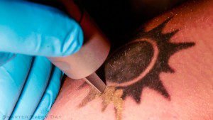 What You Need to Know When You Want to Remove a Tattoo