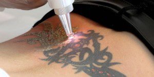 What You Need to Know When You Want to Remove a Tattoo
