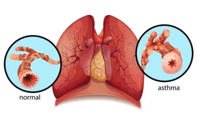 Asthma